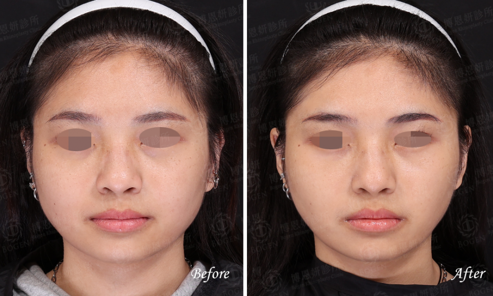 咀嚼肌肉毒,肉毒瘦小臉,博恩妍